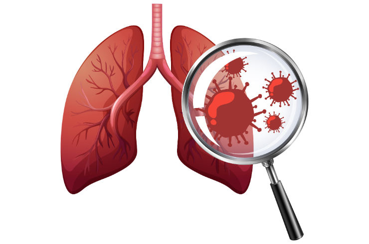Interstitial Lung Disease