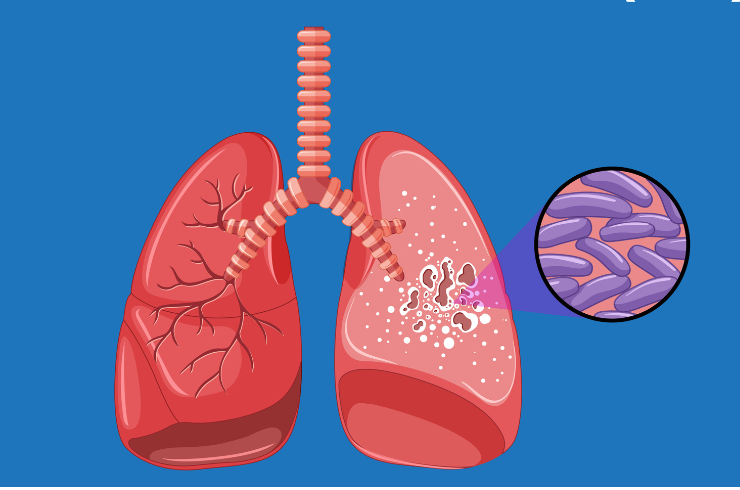 Tuberculosis Care