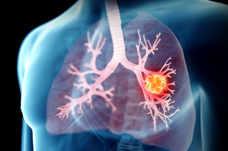 Lung Malignancies