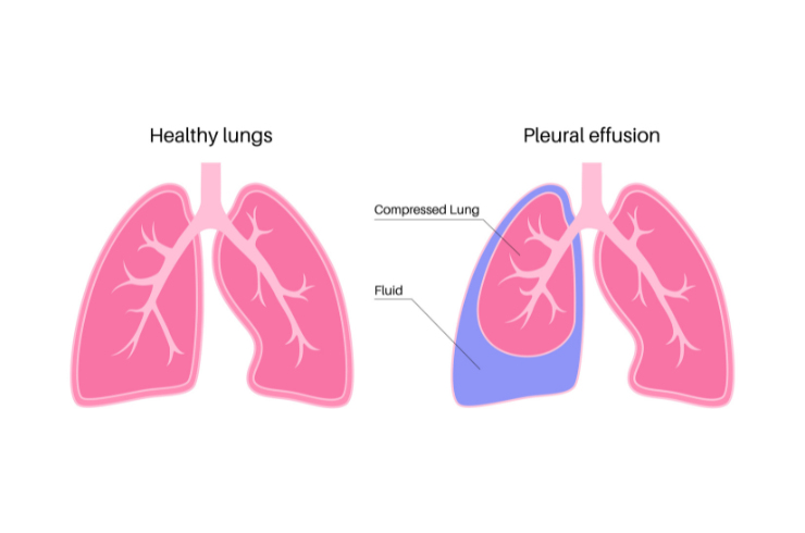 Pleural Effusion Care